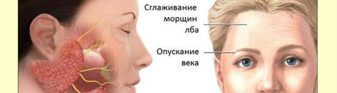 Паралич лица