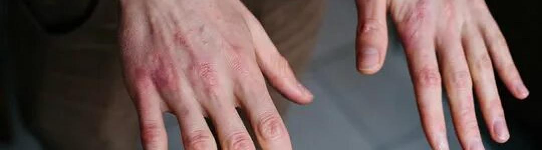 Руки и холод