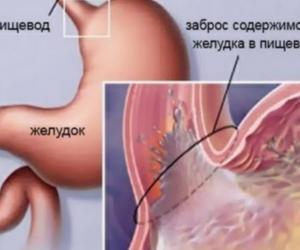 Пожар в пищеводе