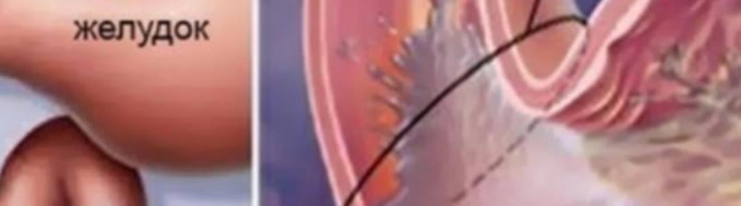 Пожар в пищеводе