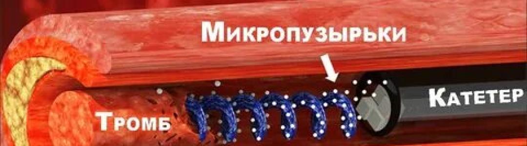 Ультразвуковая пушка